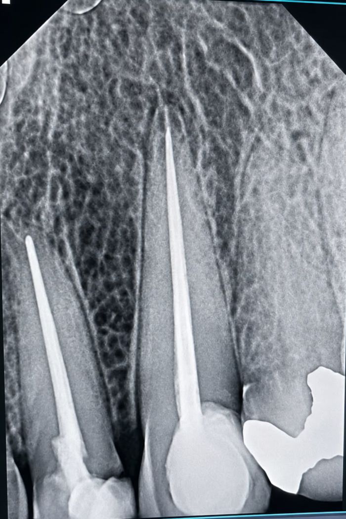 Endodoncia en OICA Dental Studio