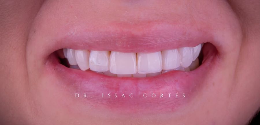 Implantes en OICA Dental Studio
