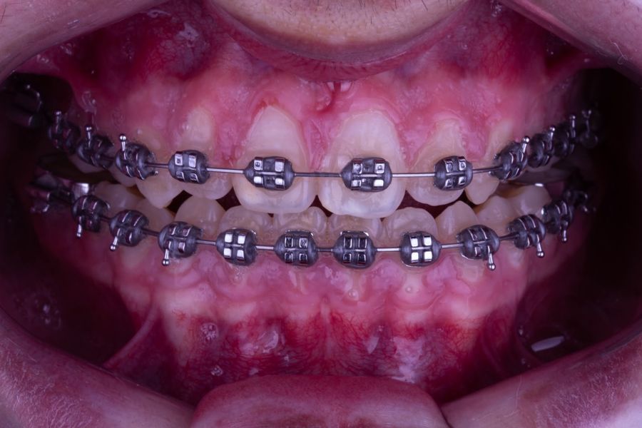 Ortodoncia en OICA Dental Studio