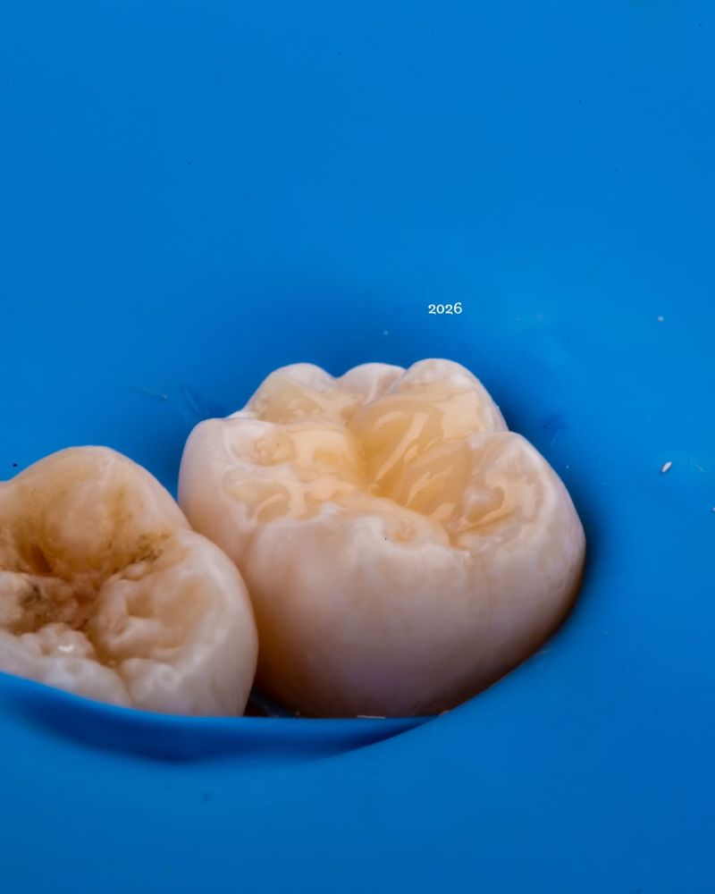 Resinas en OICA Dental Studio